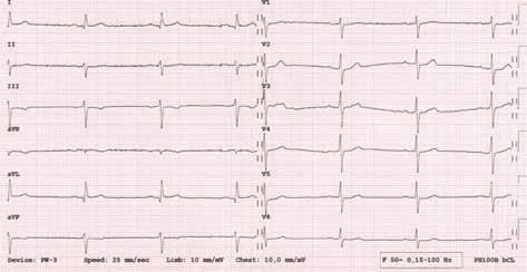 Folia Cardiologica 2016, tom 11, nr 1 Rycina 1. Bradykardia zatokowa o częstości 40/min.