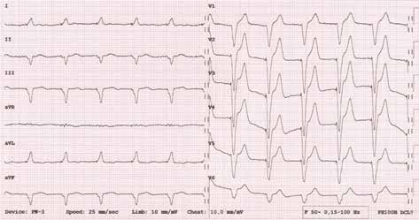 Folia Cardiologica 2016, tom 11, nr 1 Rycina 6.