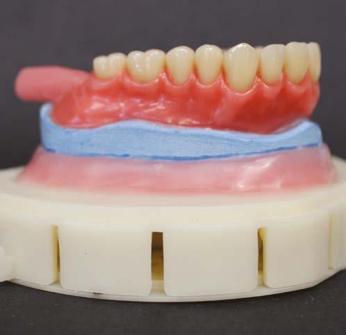 akrylowym 14 Przygotowane zęby w
