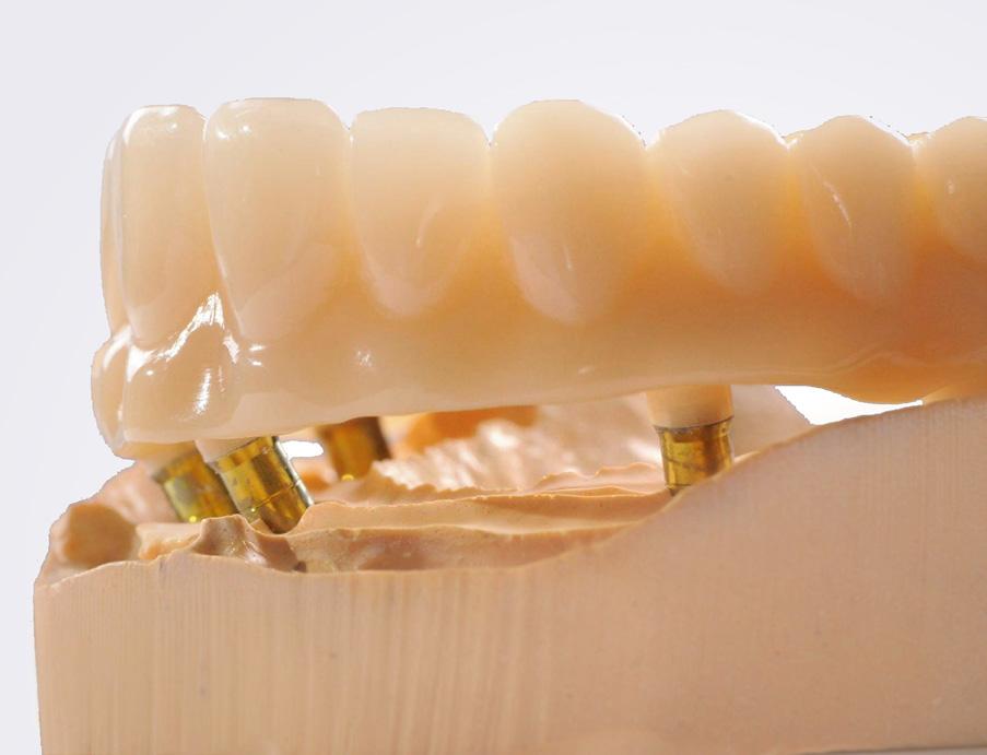 Fot. 5a. Try-In most tymczasowy z PMMA na modelu gipsowym 5a Zastosowanie wypolerowanego, monolitycznego uzupełnienia z tlenku cyrkonu ma korzystny wpływ na proces abrazji zębów antagonistycznych.