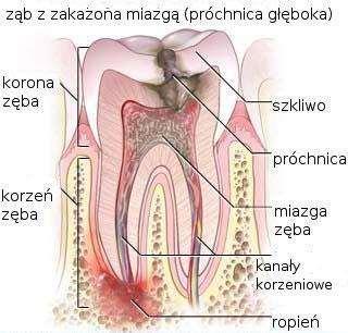 Próchnica