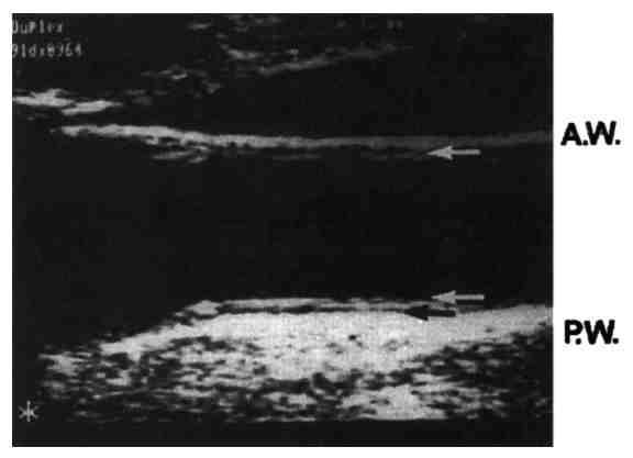 Ultrasonograficzna ocena grubości błony