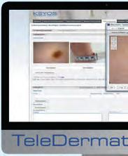 wrażenia użytkownika Teledermatologia Teledermatologia z Dino-Lite Dermascope Lekarze obecnie używający Dino-Lite uważają go za bardzo uniwersalny i łatwy w użyciu.