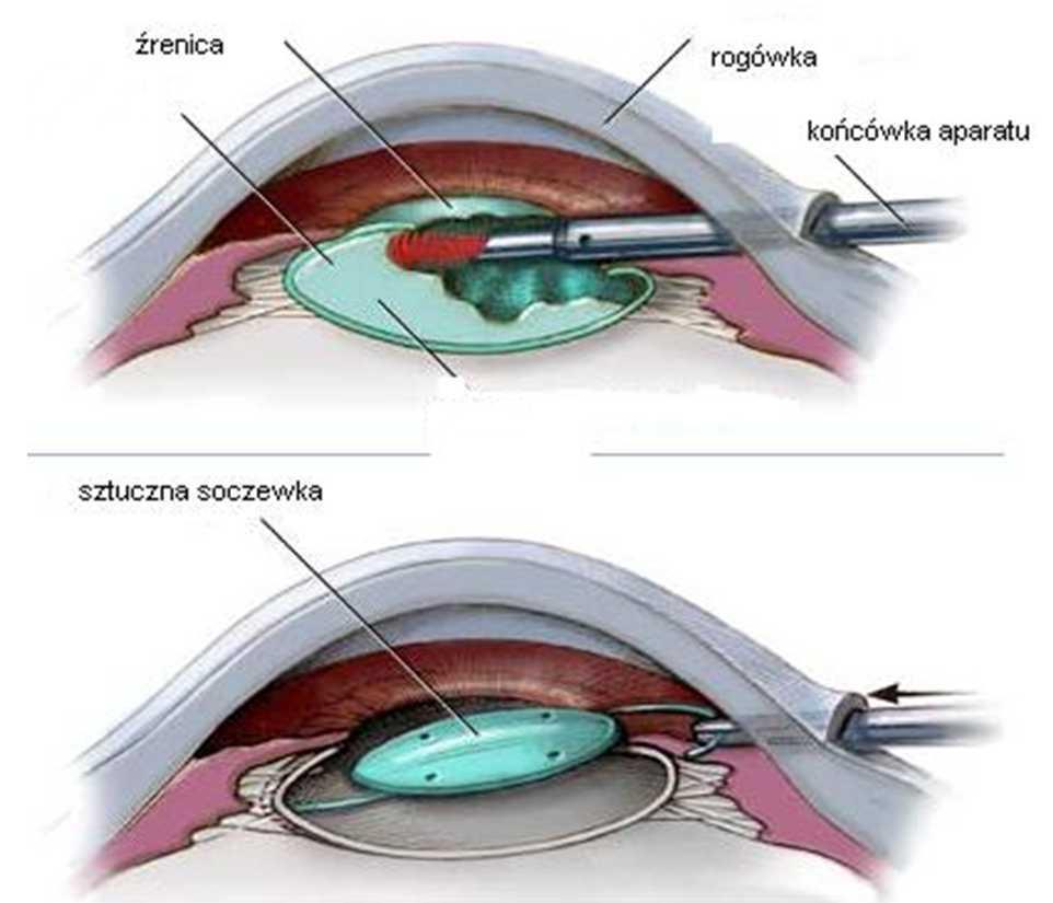 W zależności od planowanego rodzaju operacji, można zastosować znieczulenie w postaci kilku zastrzyków wokół operowanego oka lub też zastosować jedynie znieczulenie kropelkowe.