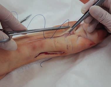 92 Jak uczyć chirurgii na studiach medycznych A B C D Rycina 4.4 a-d. Kolejne etapy zszywania rany szwem materacowym na świńskiej nóżce.