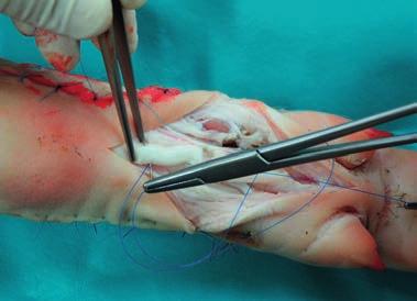 Przed rozpoczęciem zszywania ścięgien, trzeba je wypreparować ze świńskiej nóżki. W tym celu wykonuje się podłużne nacięcie skóry w miejscu, gdzie na przekroju nóżki widać odcięte ścięgna.