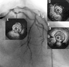 Robert Gil i wsp., Ultrasonograficzna ocena zamkniętych tętnic wieńcowych Ryc. 3. Obraz angiograficzny tętnicy zstępującej przedniej poddanej zabiegowi rekanalizacji.