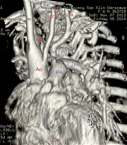 Odsznurowanie lewej tętnicy podobojczykowej u niemowlęcia z tetralogią Fallota, prawostronnym łukiem aorty i zespołem DiGeorge a. Ryc. 1. Badanie angio-ct przedoperacyjne.