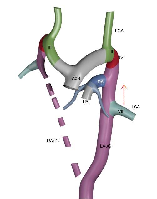 Formowanie się lewostronnego łuku aorty.