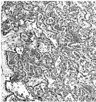 doczesnej wielojądrzaste komórki olbrzymie (trofoblastu) krwiaki