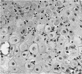częściowe niszczenie go (trofoblast inwazyjny, często komórki dwujądrzaste) udział