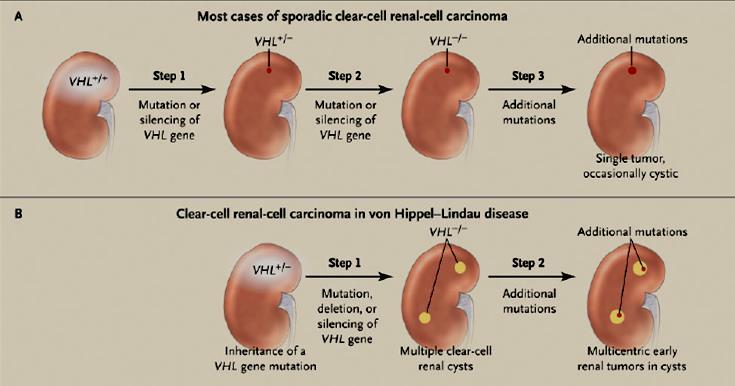 Genetyka VHL sporadyczny RNK ccrcc: Teoria 2 uderzeń 84-98% delecja jednego allelu (LOH) mutacje w