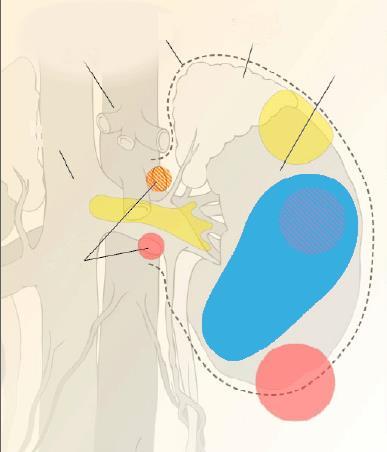 Kliniczna ocena stopnia zaawansowania i rokowanie w RCC: (Amerykańska Połączona Komisja Klasyfikacji Nowotworów Złośliwych [American Joint Committee on Cancer Criteria] 1-3 ) Aorta Powięż Geroty