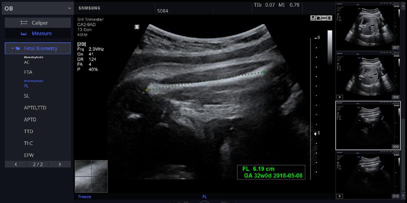 Planowanie rodziny 5D Follicle Zdrowa ciąża Diagnostyka Oprogramowanie 5D Follicle automatycznie wykrywa pęcherzyki w jajniku oraz mierzy wielkość i określa status każdego pęcherzyka, dostarczając