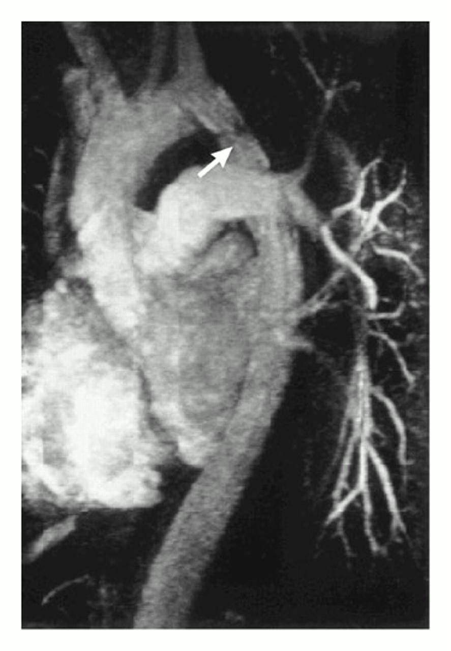 Placement of a Stent-Graft