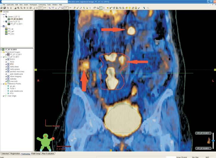 Potencial role of radiotherapy in patients with ovarian carcinoma The authors focusing on application of IORT in ovarian cancer are Gao et al. [26].