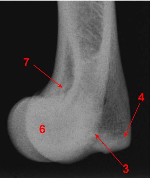 zmiany o charakterze osteochondrozy. Stąd bardzo często z ww. jednostkami chorobowymi współistnieje niezgodność stawowa (1, 2, 4, 9).