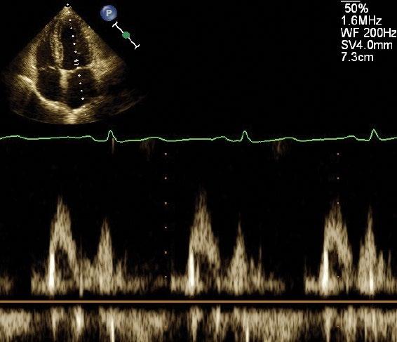 Prawidłowy dwufazowy napływ do lewej komory przez zastawkę mitralną w rejestracji dopplerem wiązki pulsacyjnej z projekcji koniuszkowej czterojamowej Zastawka mitralna Obraz zastawki mitralnej