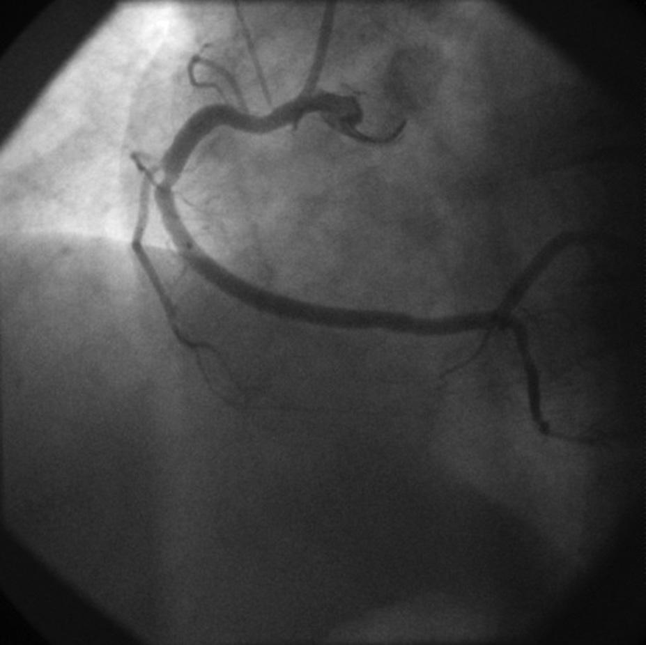 Folia Cardiologica 2015, tom 10, nr 5 Rycina 1. Istotne zwężenie w odcinku środkowym prawej tętnicy wieńcowej Rycina 2.
