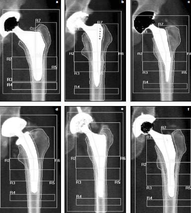 Wstęp Krótki trzpień oszczędzający kość poprzez: Wyższy poziom resekcji szyjki kości udowej nie naruszający jej obwodowej integralności