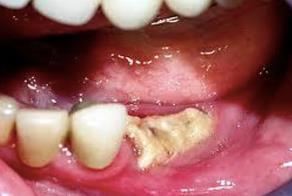 objawy zwiastunowe ONJ ból obrzęk/stan zapalny dziąsła ruchomość zębów utrata zębów