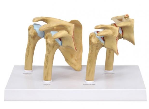 Model choroby zwyrodnieniowej / Osteoartrozy obręczy barkowej, 4 stadia Nr ref: MA01205 Informacja o produkcie: Model - osteoartroza obręczy barkowej, 4 stadia Prezentowany produkt to zestaw 4 modeli