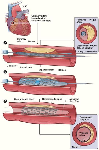 2.3. Sposób implantacji Implantacja stentu przebiega w następujący sposób: a) wprowadzenie do tętnicy cewnika zakończonego balonikiem, na który nałożony jest stent, b) rozprężanie balonu, poprzez