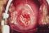 Рак шейки матки во время беременности. Диагностические трудности и осложнения