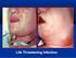 Odontogenic Inflammations of Head and Neck Region Treated in Maxillofacial Ward in Regional Specialistic Hospital in Rzeszow Five-Year Observation