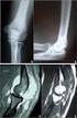 Chondromatosis of the elbow. A case report Chondromatoza stawu łokciowego. Opis przypadku