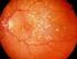 The Complications of Age-related Macular Degeneration Prevention Trial (CAPT) Research Group