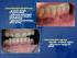 Wpływ wybranych uwarunkowań miejscowych na powstawanie zespołu pieczenia jamy ustnej