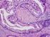 A rare case of serous cystadenocarcinoma of the pancreas