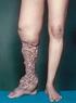 Lymphoscintigraphy of lower limbs in differential diagnosis of patients treated surgically for chronic venous insufficiency