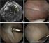 Role of lateral release in patellofemoral joint pathology Rola uwolnienia bocznego w patologii stawu rzepkowo- -udowego