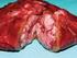 Artyku przeglàdowy. Przerzuty do mózgu u chorych na raka piersi post powanie i rokowanie na podstawie przeglàdu piêmiennictwa