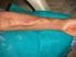 Forearm radiocephalic fistula for dialysis