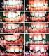 The Index of Orthodontic Treatment Need (IOTN) in a group of school-aged children...