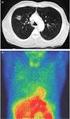 Differential diagnosis of a solitary pulmonary nodule of the lung on the grounds of selected laboratory tests and radiological examination