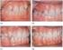 Assessment of indications for extraction of permanent teeth and of their number during orthodontic treatment
