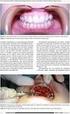 Leczenie chirurgiczne 14-letniej pacjentki z zatrzymanym zębem 22, po niepowodzeniu leczenia ortodontycznego