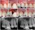 Clinical comparison of two minimally invasive methods of caries treatment in deciduous teeth*