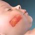 MARSI. (ang. MARSI - Medical Adhesive - Related Skin Injuries)