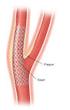 The effect of stent coating on stent deliverability: direct randomised comparison of drug eluting and bare metal stents using the same stent platform