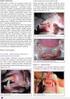 Rak płaskonabłonkowy przedsionka nosa i wargi górnej o agresywnym przebiegu opis przypadku