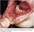 Oral mucosa state in adults with Crohn s disease in relation to disease activity, treatment methods and smoking