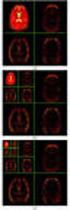 ENTROPY OF DISCRETE WAVELET TRANSFORM AND RADIAL NEURAL NETWORKS AS A DIAGNOSIS TOOL OF DIESEL ENGINE EXHAUST VALVE FAULT