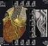 Wskaźnik uwapnienia tętnic wieńcowych nieinwazyjna metoda wykrywania i oceny miażdżycy tętnic wieńcowych