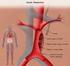 Treatment of a thoracoabdominal aortic aneurysm dissection with iliac artery aneurysms complicated by an internal iliac artery aneurysm rupture