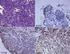 Pancreatic neuroendocrine tumor a case report